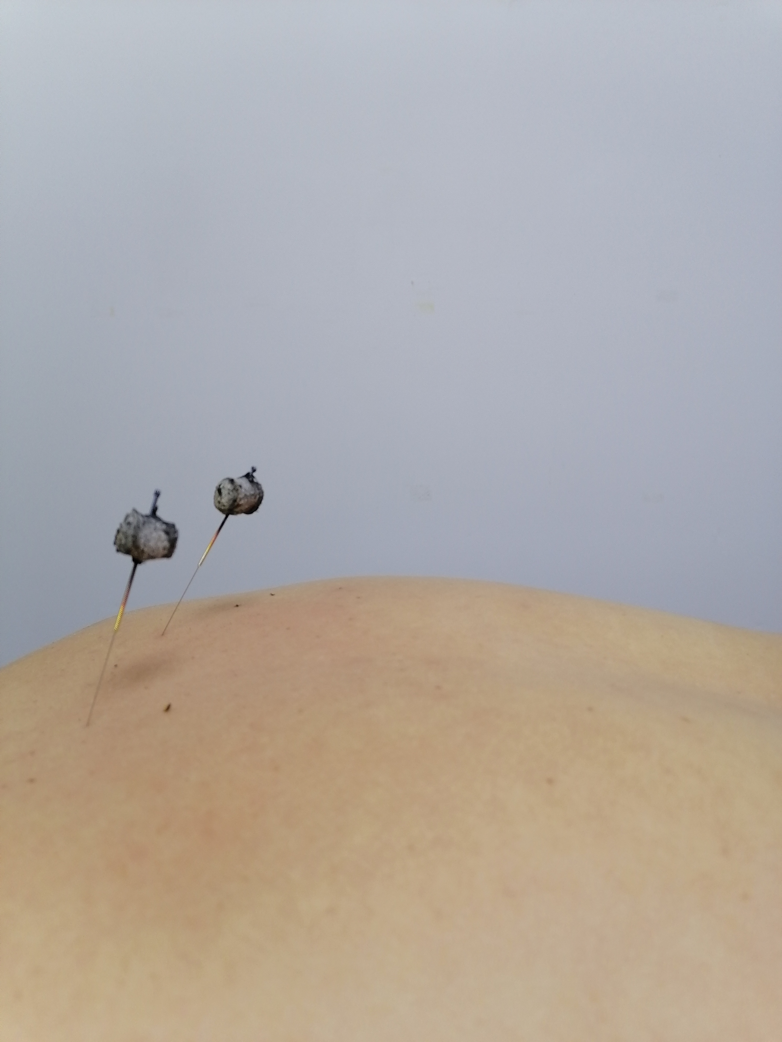 Прогревание акупунктурных игл  китайской полынью для лечения болей в спине